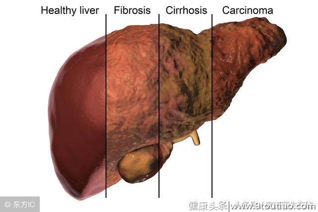 肝硬化不能治愈？千万不要放弃治疗，坚持或许可逆转