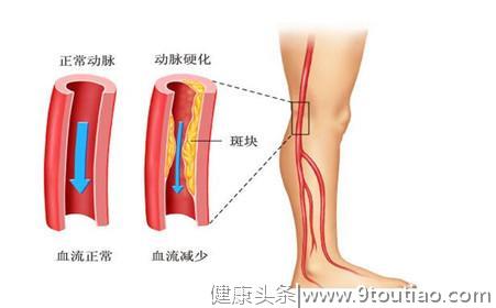 腿疼抽筋一定是缺钙吗？告诉你，还可能是这种严重性疾病！