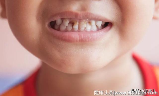 儿童龋齿逐年上升，比刷牙更重要的是这几件事，预防工作刻不容缓