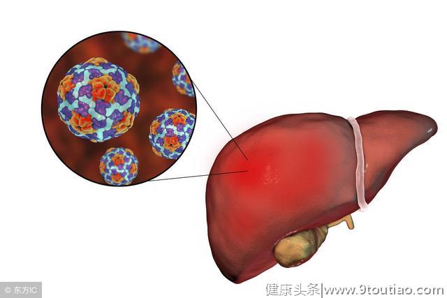 肝炎极易恶化为肝癌！做好5件事，将肝癌“拒之门外”