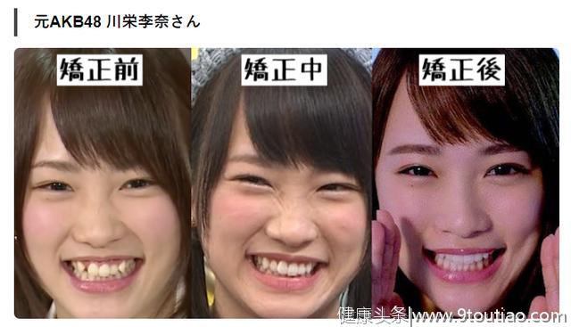 为什么很多日本人的牙齿不好看？
