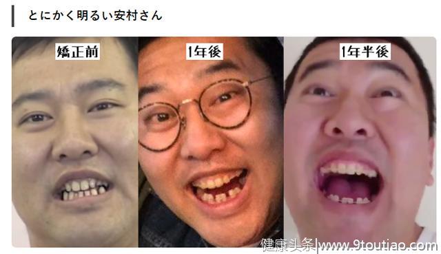 为什么很多日本人的牙齿不好看？