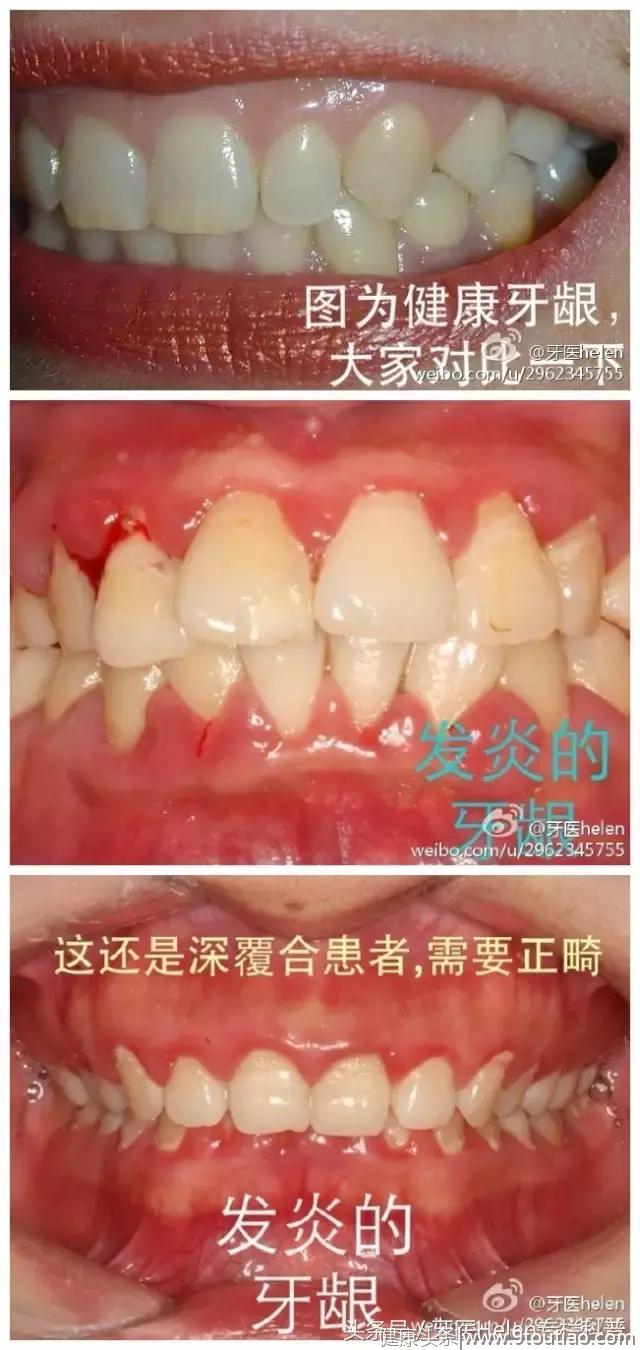 牙医Helen齿科中心——牙周炎