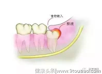 撕逼大作战 你的智齿 到底要不要拔？不痛就不需要拔吗？