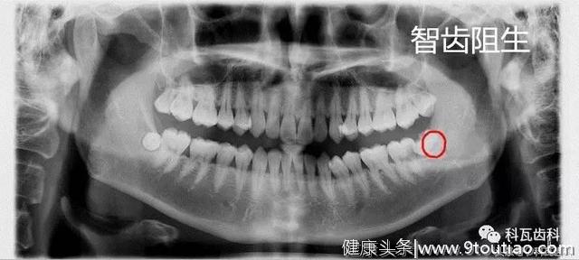 撕逼大作战 你的智齿 到底要不要拔？不痛就不需要拔吗？