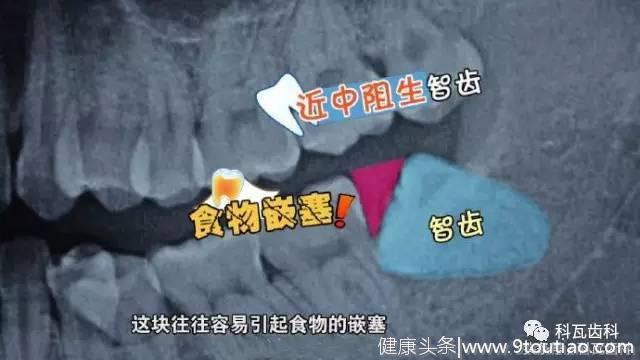 撕逼大作战 你的智齿 到底要不要拔？不痛就不需要拔吗？