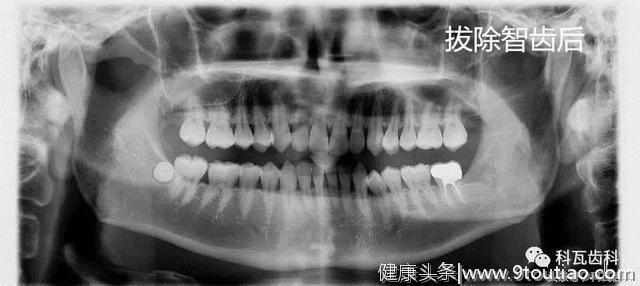 撕逼大作战 你的智齿 到底要不要拔？不痛就不需要拔吗？