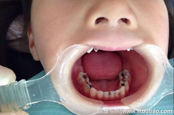 老担心家里小孩蛀牙？别急，有种预防蛀牙的方式你可能没试过