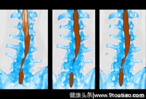 常见腰痛的原因及缓解方法