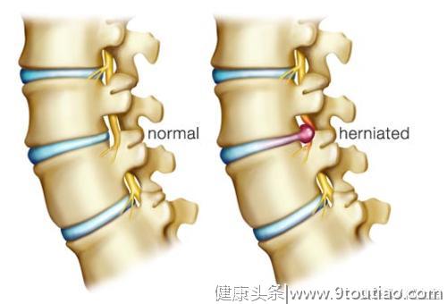 常见腰痛的原因及缓解方法