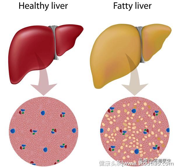 什么是脂肪肝，它会怎么影响我们的健康？如何消除脂肪肝？