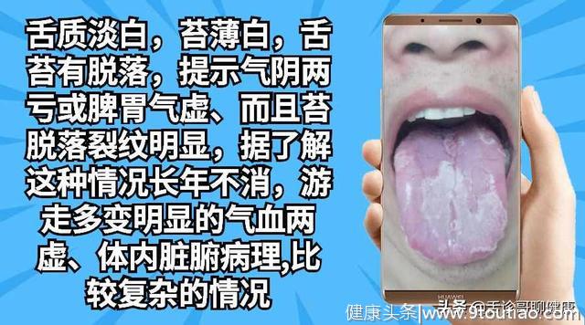 口腔溃疡、记忆力减退、总是焦虑烦躁等舌象的分析与感悟