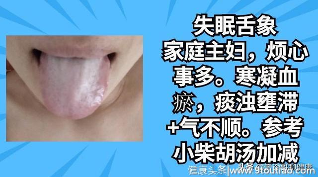 口腔溃疡、记忆力减退、总是焦虑烦躁等舌象的分析与感悟