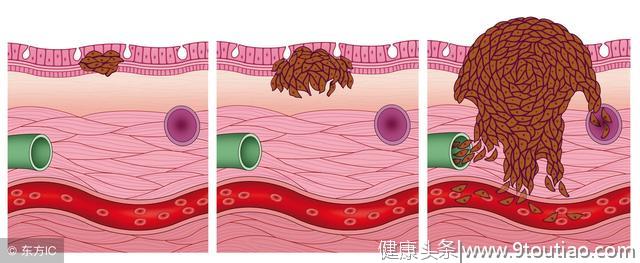 造成皮肤癌是什么原因呢