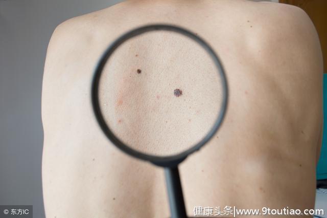 造成皮肤癌是什么原因呢