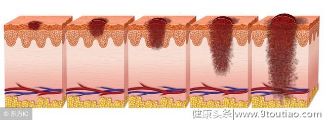 造成皮肤癌是什么原因呢