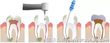 嘎嘣脆！牙齿居然裂了，不是说好的人类最坚硬的器官？