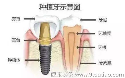 种完牙以后，我能马上吃东西吗？