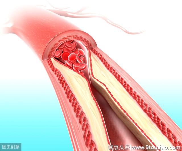 冠心病没有症状就好了？医生辟谣：千万不要被假象欺骗