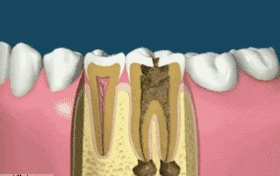 做了那么贵的根管治疗后，牙医还要我戴牙冠，为什么？