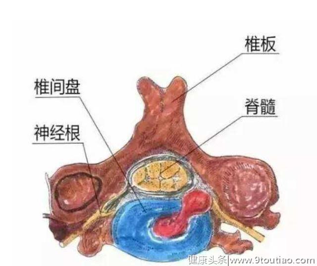 颈椎病最好不要做手术？不懂颈椎病指征怎么办？四句话读懂颈椎病