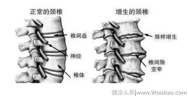 颈椎病最好不要做手术？不懂颈椎病指征怎么办？四句话读懂颈椎病