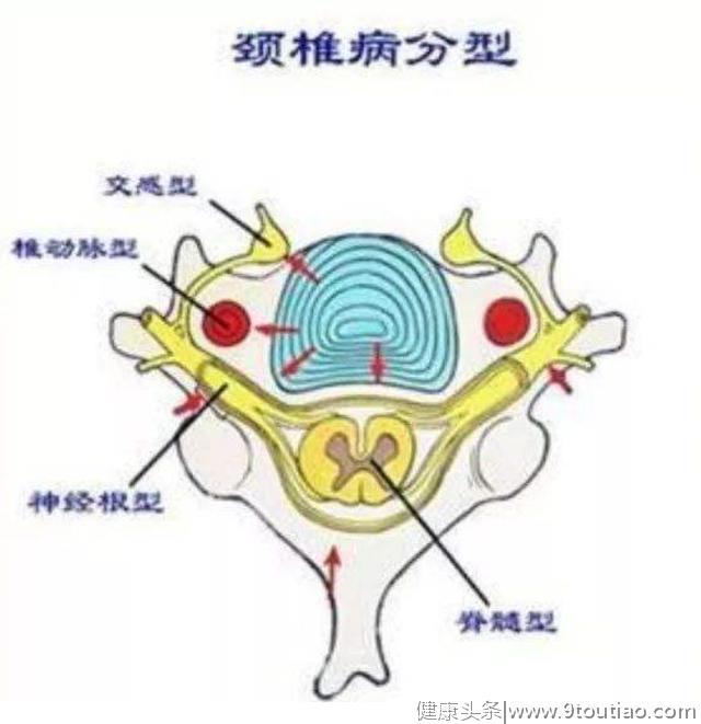 颈椎病最好不要做手术？不懂颈椎病指征怎么办？四句话读懂颈椎病