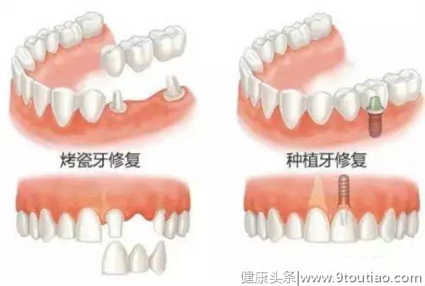 牙齿损害到什么情况，才需要做牙冠？