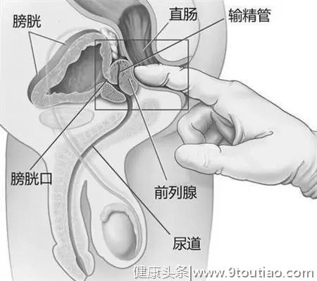 关于前列腺癌，你知道多少？