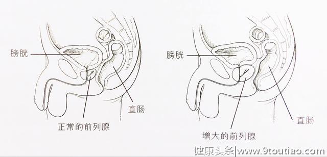 前列腺该如何保养？