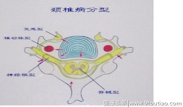 什么是颈椎病？具体情况是哪些？