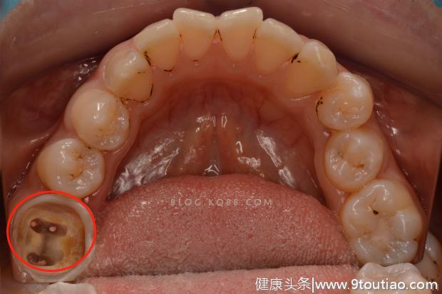 牙齿残根不疼就没事，别管它；牙医：口腔癌就是这么来的