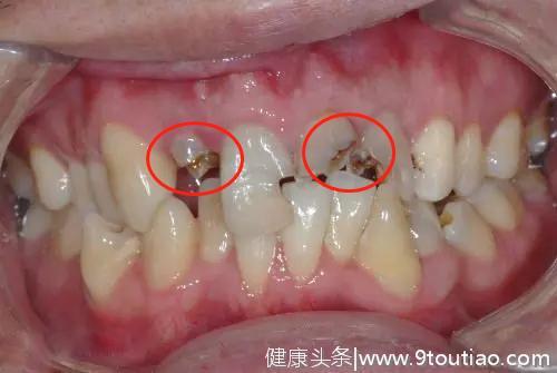 牙齿残根不疼就没事，别管它；牙医：口腔癌就是这么来的