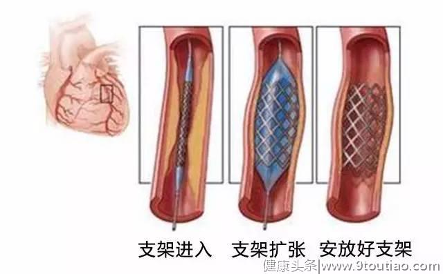 得了心脏病，最终都需要支架治疗吗？心血管医生讲出大实话！