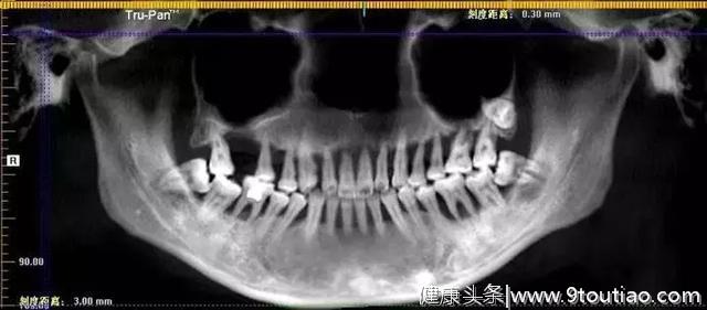 28岁美女牙齿全被拔光，只因患了牙周炎，这是不是医生误诊？