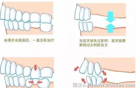 别再说种牙贵了，我只能说“种牙越早越省钱”...