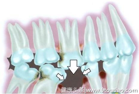 别再说种牙贵了，我只能说“种牙越早越省钱”...