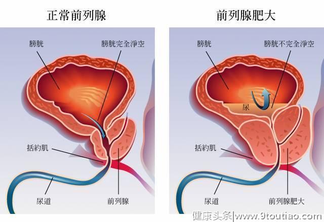 泌尿外科医生：经常尿血、尿痛、骨痛？当心是前列腺癌