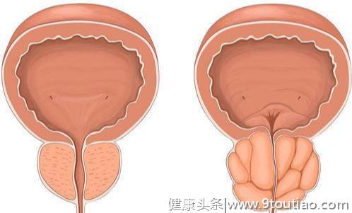 泌尿外科医生：经常尿血、尿痛、骨痛？当心是前列腺癌