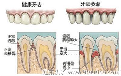 为什么牙齿变得越来越长？什么是牙龈萎缩？资深牙医教你如何预防