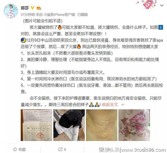 知名女星拔火罐被烧伤！专家：拔罐虽好，可别“引火烧身”