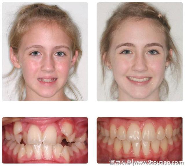 牙齿矫正可以改变脸型吗？什么样的人适合正畸？专业牙医告诉你