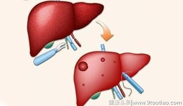 早期肝炎的5种表现