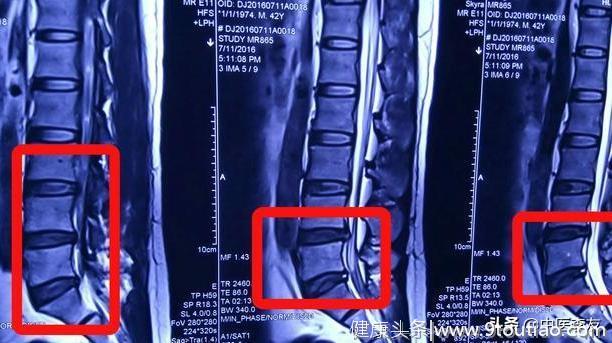 一文读懂腰痛，椎间盘突出与椎管狭窄的中医诊断，影像显示