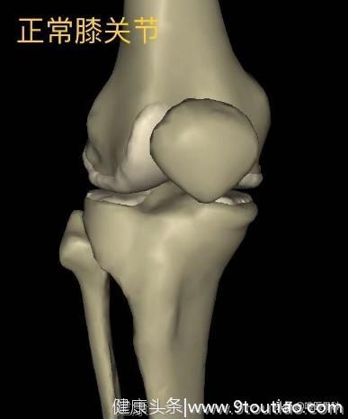 「 膝关节骨质增生」一共有 5 级，你已经到了几级？