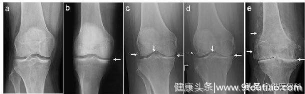 「 膝关节骨质增生」一共有 5 级，你已经到了几级？