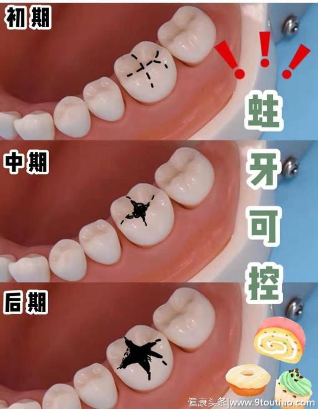 牙齿上的小黑点为什么刷不掉？到底是什么？别让侥幸毁了你一口牙