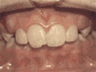 8种需要牙齿矫正的常见牙畸形情况你知道几个