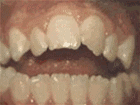 8种需要牙齿矫正的常见牙畸形情况你知道几个