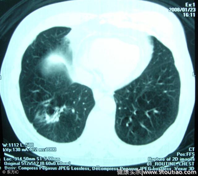 引起肺癌的主要原因是什么？具体如下几点